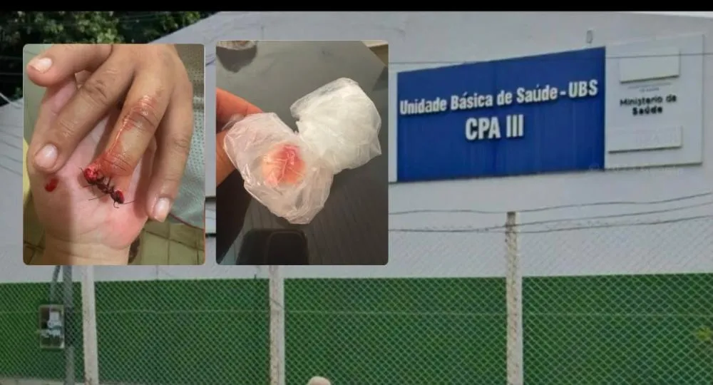 Mulher tem dedo amputado após maca ceder na UBS do CPA III; paciente afirma que enfermeira disse que acidente ocorreu por causa de seu peso